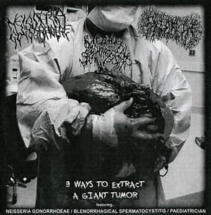 3 Ways To Extract A Giant Tumor